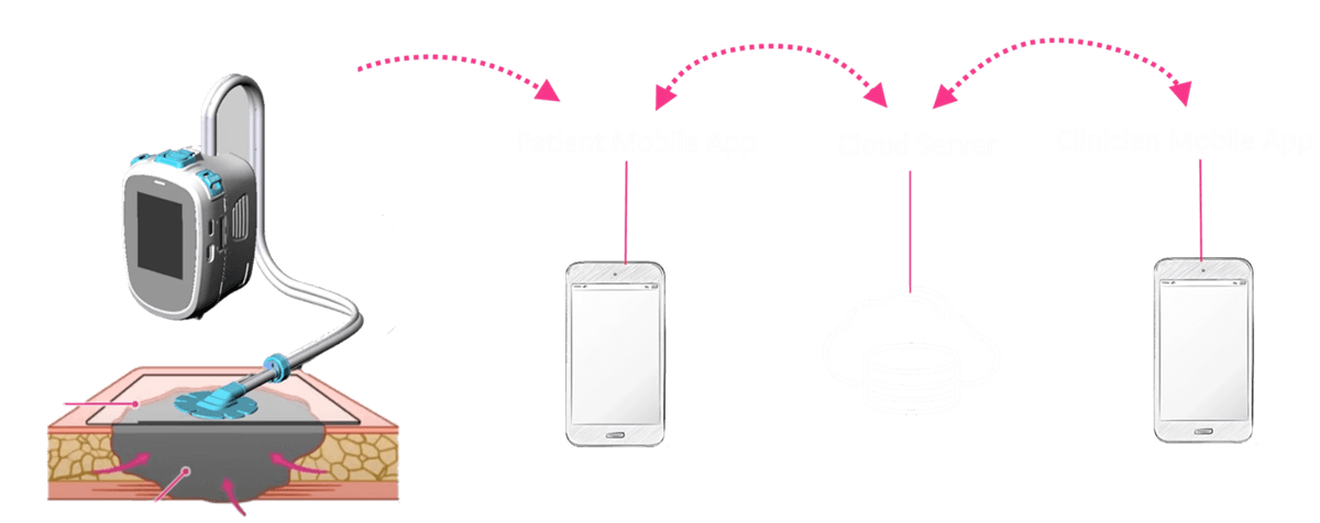 Remote NPWT platform architecture