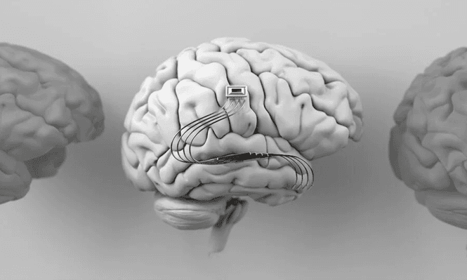 Brain Shunt Position Indicator